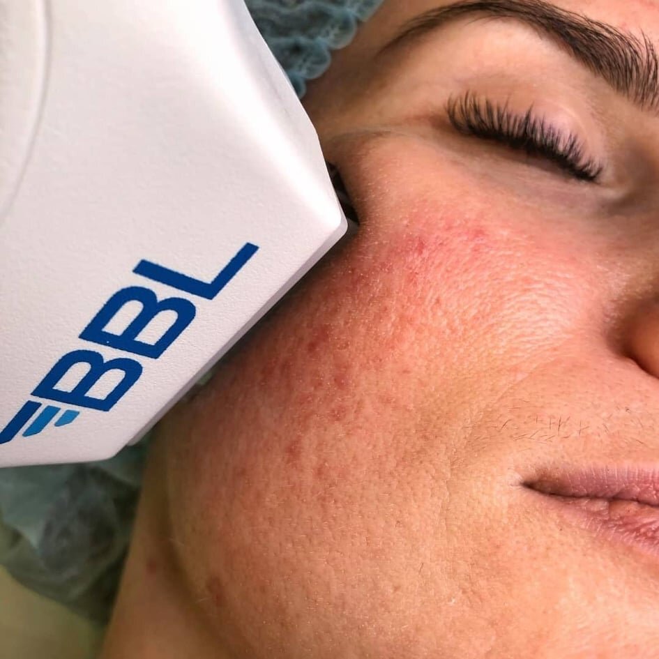 лечение купероза, розацеа на аппарате BBL Hero