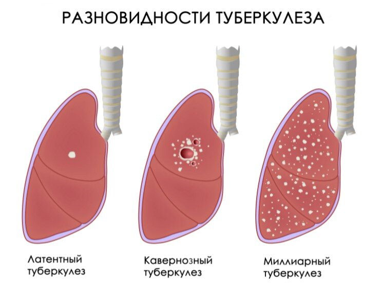 Разновидности туберкулёза