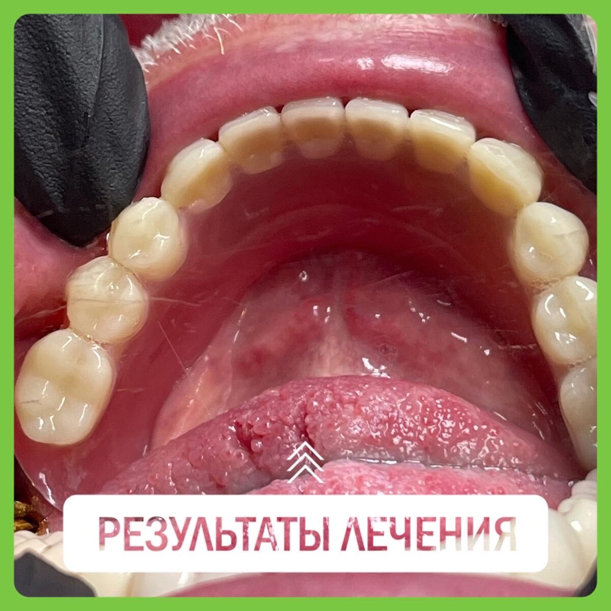 Условно-съемное протезирование зубов в Сочи