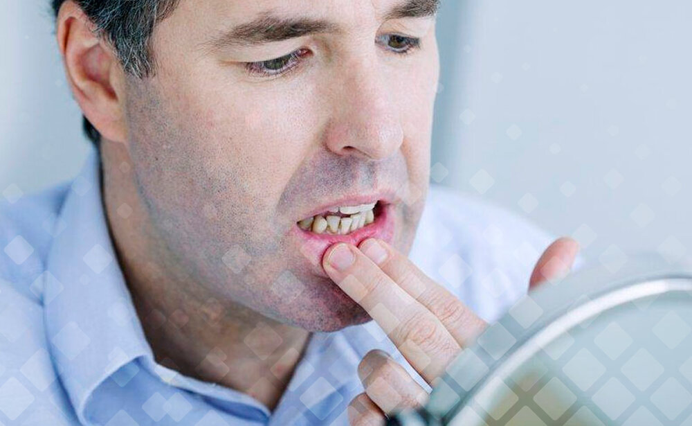 Молочница – достаточно неприятное заболевание. Чаще всего встречается у женщин, но мужчины – также не исключение. Фото: Яндекс.Картинки. 