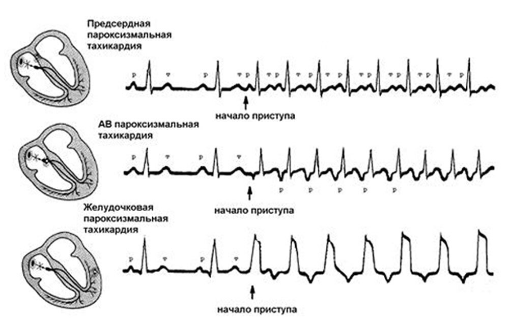 Пока тахикардия не будет зафиксирована на ЭКГ (здесь я подразумеваю ЭКГ в широком смысле - в том числе и холтеровский монитор ЭКГ, и запись электрограммы сердца при электрофизиологическом исследовании) - невозможно точно решить, какая именно это тахикардия