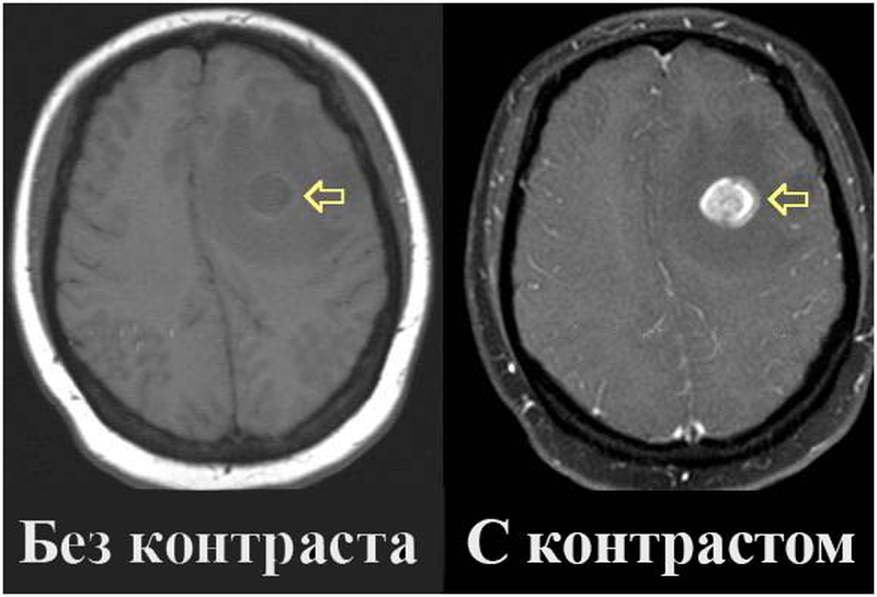 Разница кт и кт с контрастом. Мрт головного мозга с контрастированием. Мрт с контрастом. Мрт головы с контрастом. Магнитно резонансная томография с контрастом головного мозга.