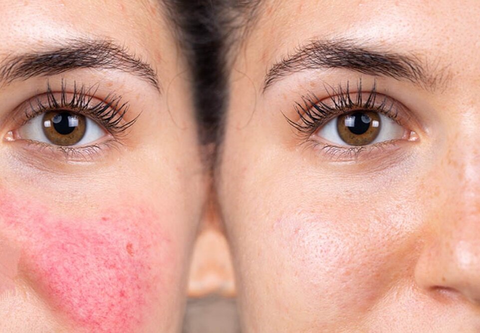  Дело в том, что для кожи это — шоковая терапия, провоцирующая микроспазм сосудов с последующим их расширением. Кубик льда - не лучшая идея для ежедневного умывания