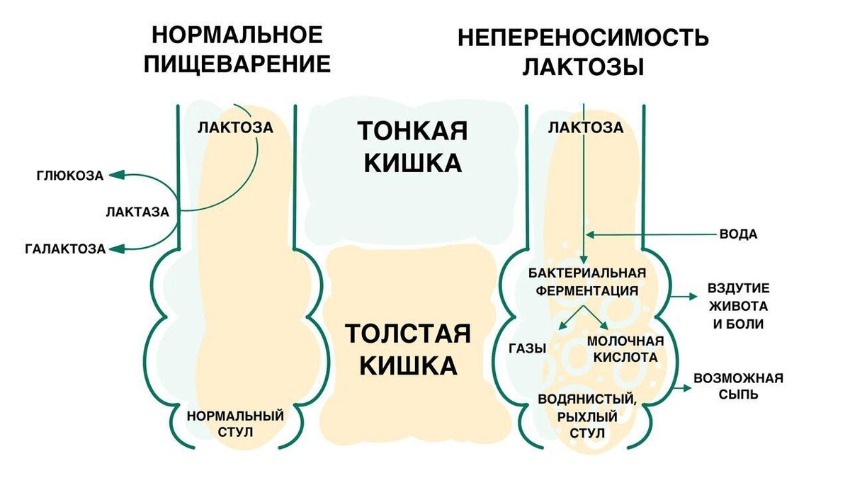 Развитие колик при лактазной недостаточности. Источник: МедПортал