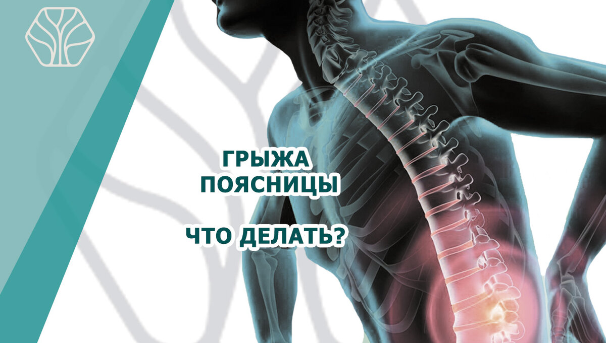 Поясница — самый перегруженный отдел позвоночника. Лечение грыжи поясничного отдела может быть консервативным и хирургическим