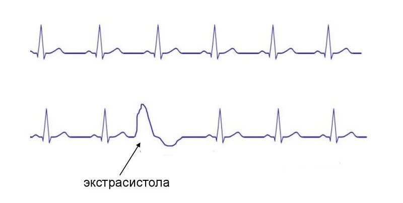 Обратите внимание, среди красивых, одинаковых по длительности и рассеянию между собой нормальных сокращений - одна уродливая, широкая, выпадающая из общего ритма экстрасистола.