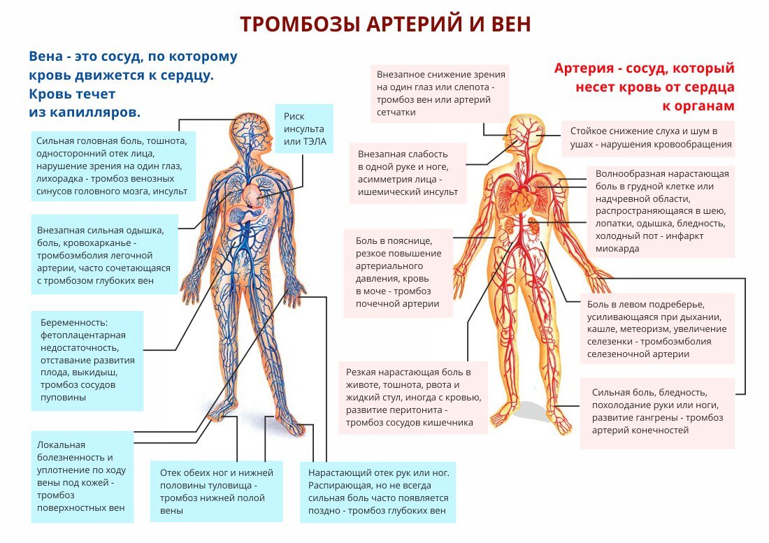 Тромбоз: кто в группе риска и 12 способов профилактики | Дневник здоровья |  Дзен