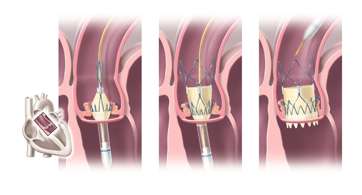 Транскатетерная имплантация митрального клапана