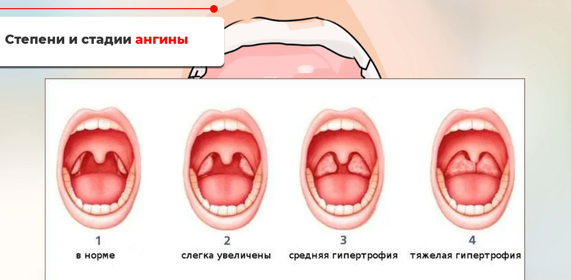 Острый тонзиллит — Википедия