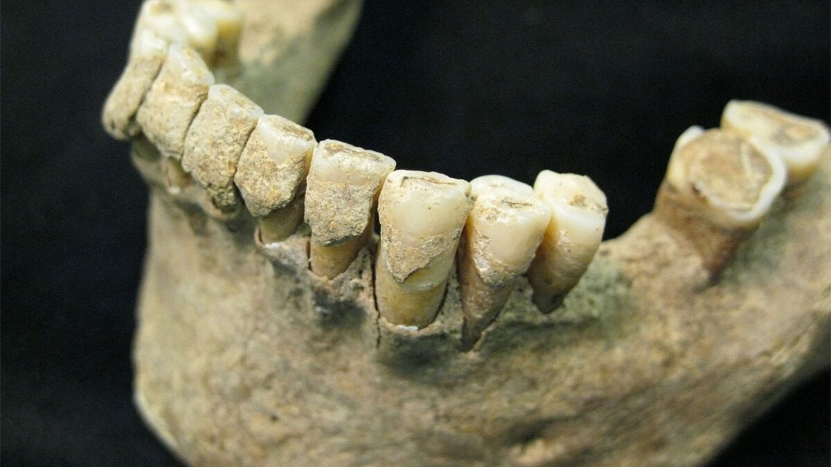 Зубные протезы в древности