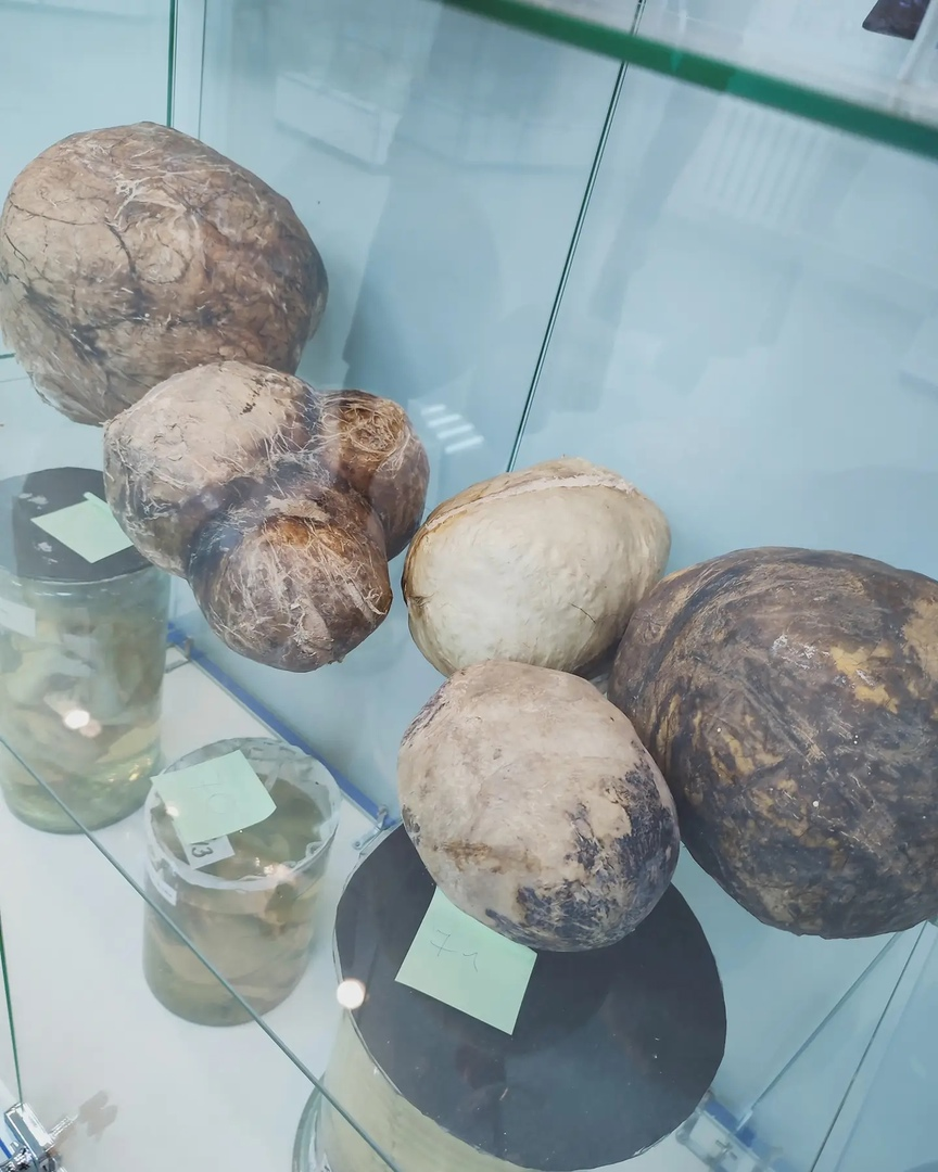 Гигантские опухоли человека