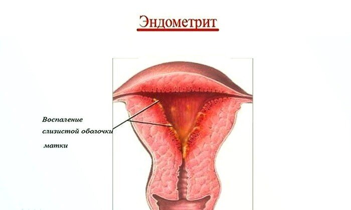 Эндометрит хронический картинки