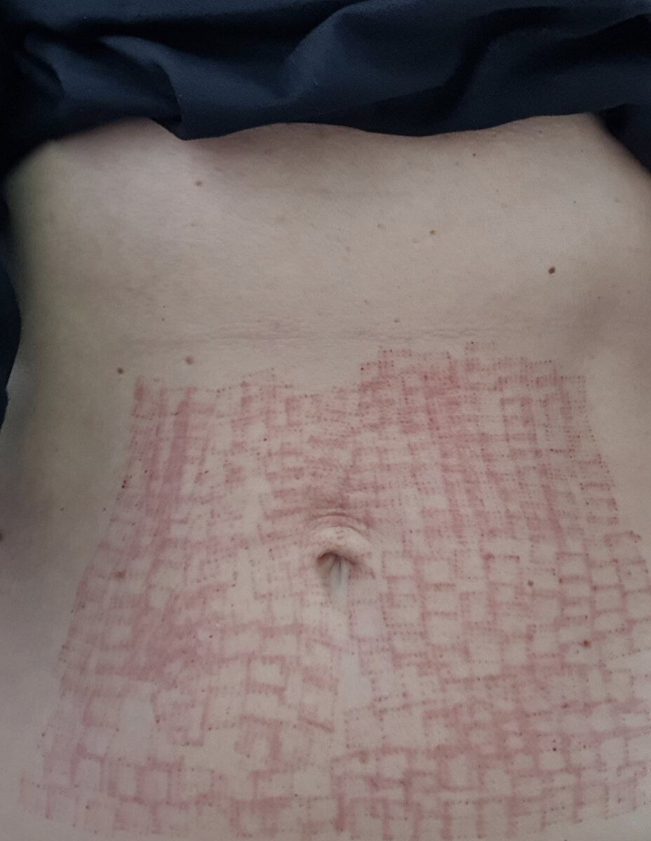 Обработанная аппаратом зона сразу после процедуры.