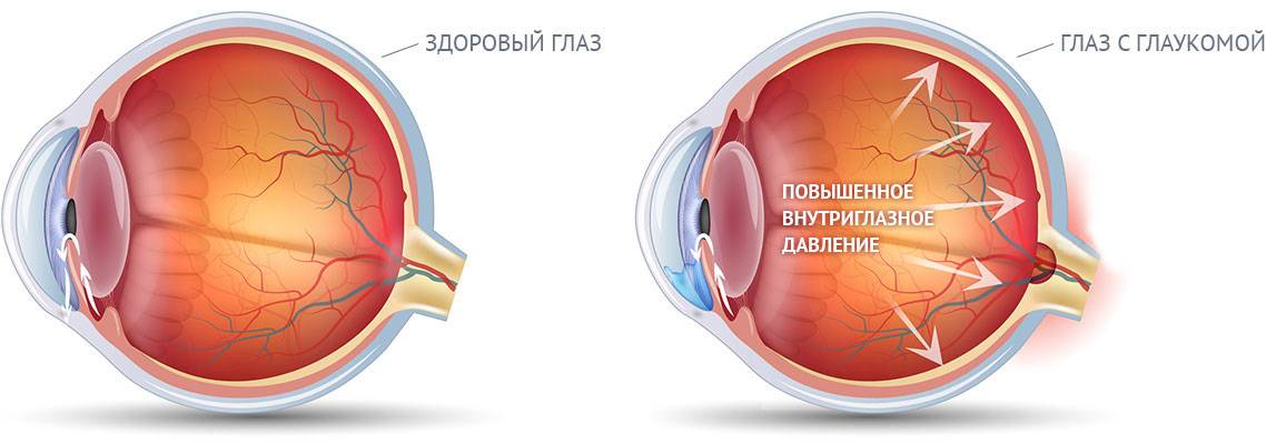 Медицина глаукома. Терминальная глаукома.