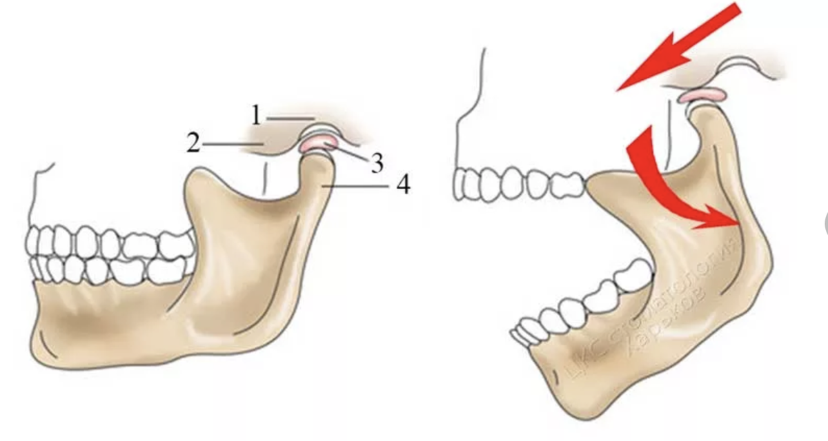 Движение суставной головки ВНЧС. Нижнечелюстной подвывих челюсти.