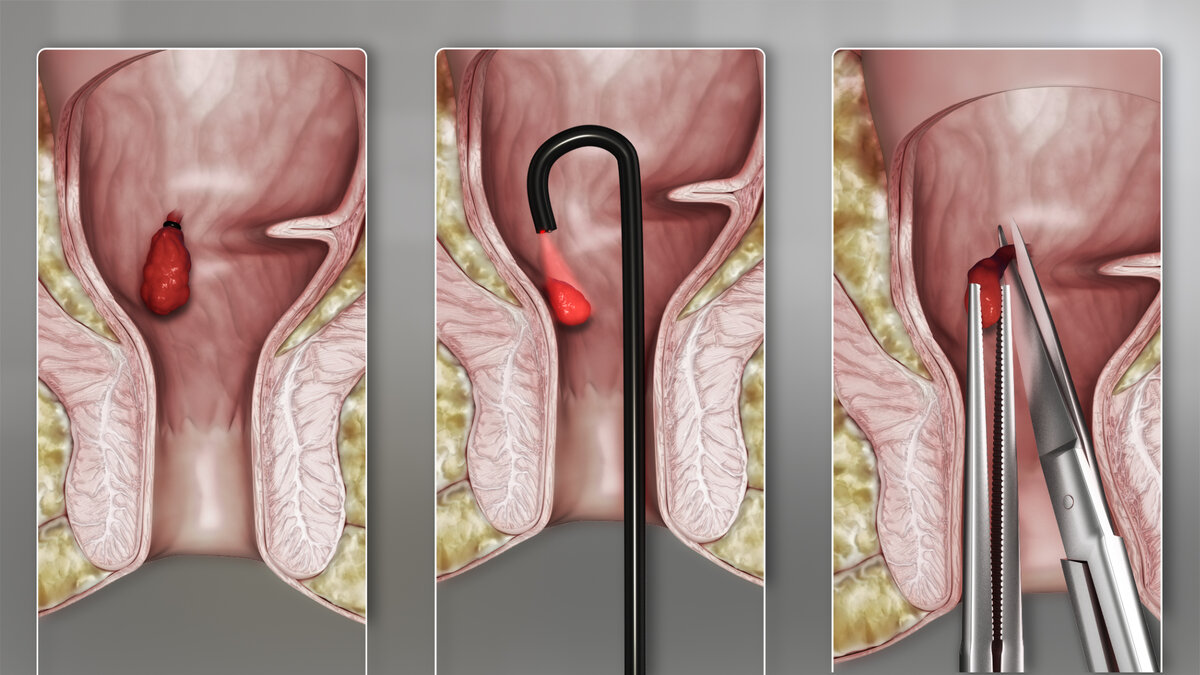 Лечение геморроя в домашних условиях