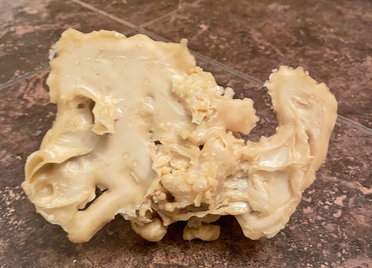 Женщина 45 лет. Страдала алкоголизмом со всеми вытекающими последствиями.  За 9 сеансов была снята алкогольная лярва. 