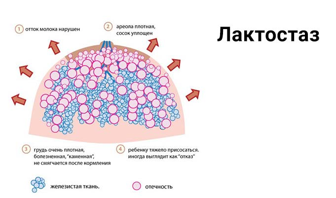 О чём говорят уплотнения в груди и как от них избавиться - Лайфхакер