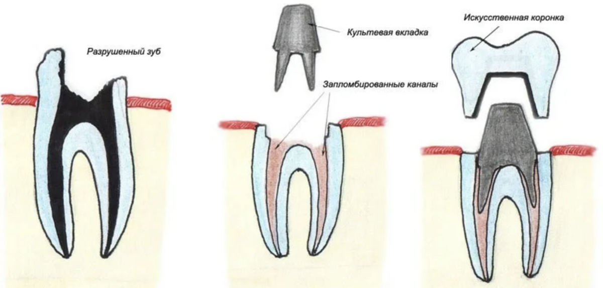 Сломался зуб под корень – что делать?