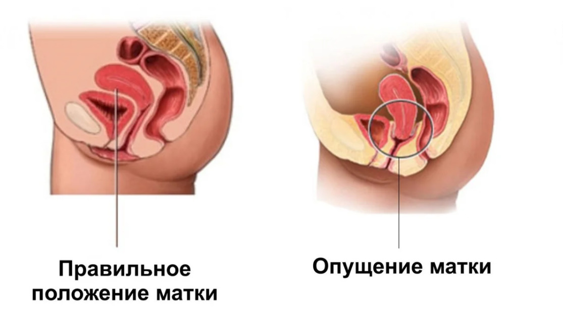 Опущение и выпадение влагалища и матки