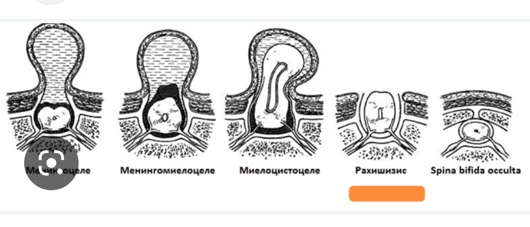 Картинка из интернета, у сына был рахишизис