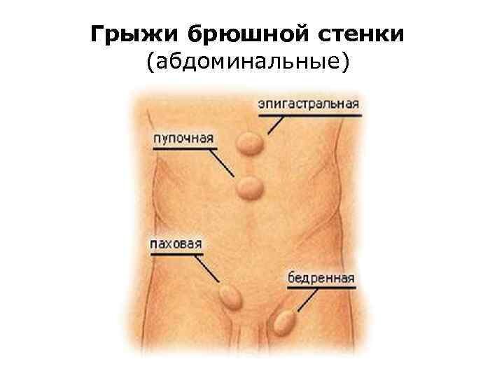 Грыжи передней брюшной стенки презентация