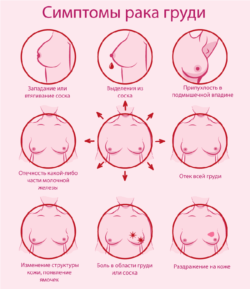 Рак молочной железы прогноз