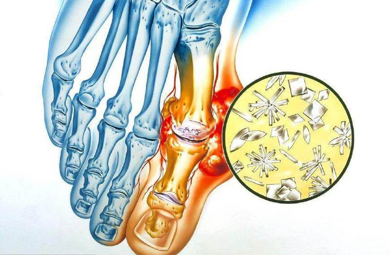 Как выглядит отложение солей. Массаж шейно-воротниковой зоны при остеохондрозе. Ревматоидный артрит тофусы. Диета при отложении солей. Массаж шейно-воротниковой зоны при остеохондрозе.