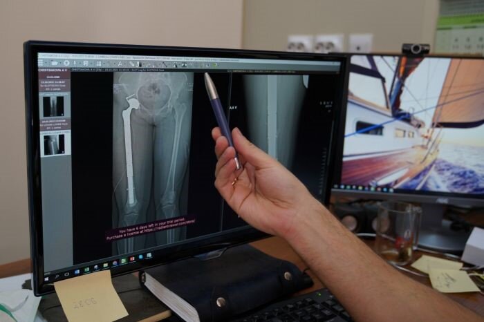 На снимках хорошо видно расположение эндопротеза