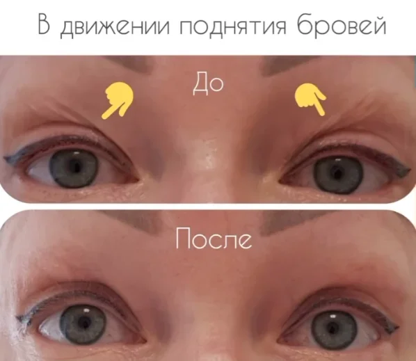 Микроигольчатый RF-лифтинг на аппарате Scarlet. Фото до и после. Фото с сайта Д.Р. Гришкяна. Имеются противопоказания, требуется консультация специалиста