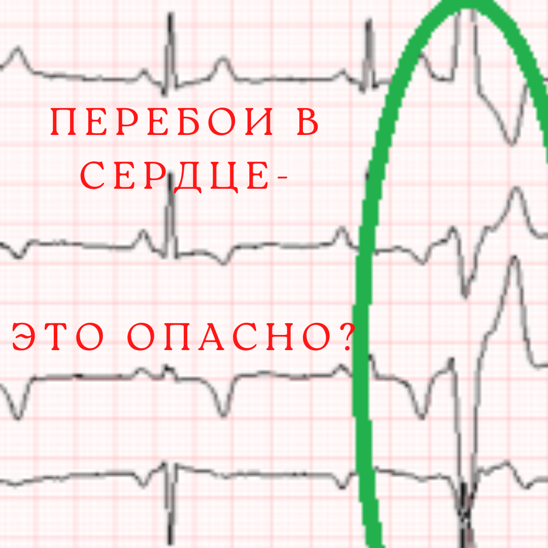 Перебои в сердце- это опасно? | Стоп аритмия! Кардиолог - аритмолог Елена  Ефимова | Дзен