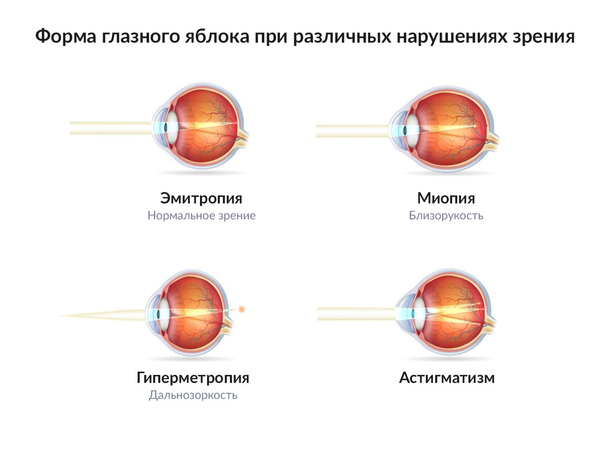 Признаки близорукости