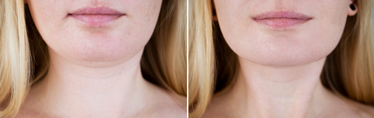 4 подбородок. Body and face correction Lipolitik.