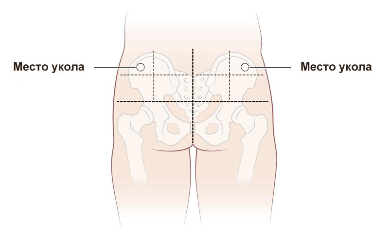 Укол в ягодицу как правильно фото