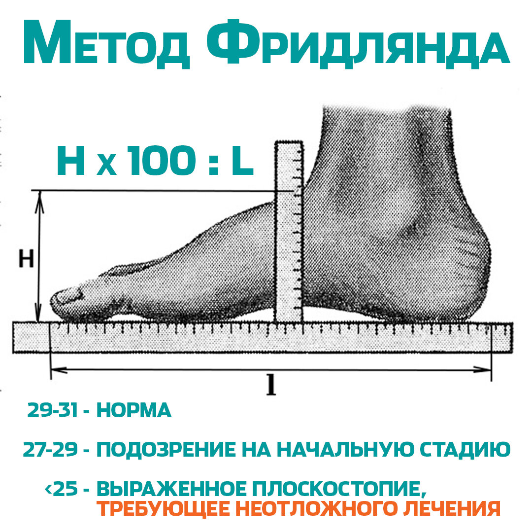 Как понять, есть плоскостопие или нет? | Доктор ОСТ | Центр лечения ...