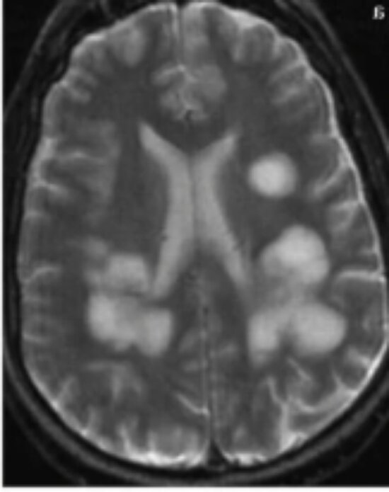 Мрт не моё. Моё на диске. Примерно так сейчас выглядят облака в моей голове. 
