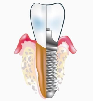При одномоментной имплантации все процедуры выполняются в один день.