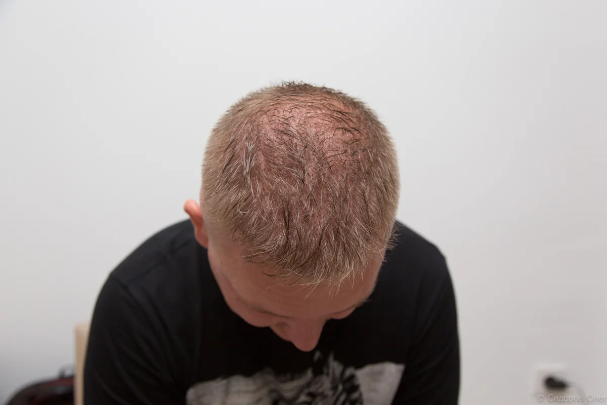 На фото - голова на следующий день после пересадки волос DHI