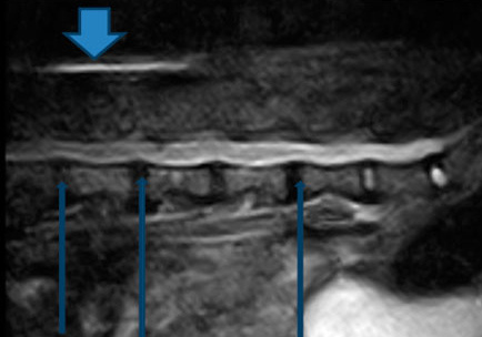  Рис. 1. МРТ таксы, которую лечили пиявками. Толстая стрелка - действие пиявок на подкожную клетчатку. Отек. Тонкими стрелками показана компрессия спинного мозга. Остается загадкой, как пиявки могут воздействовать на гиалиновый хрящ, вызвавший компрессию. Ответ прост: никак! 70 % такс выздоравливают самостоятельно, именно на этом фате основано псевдолечение пиявками, хондролоном и другими пищевыми добавками.