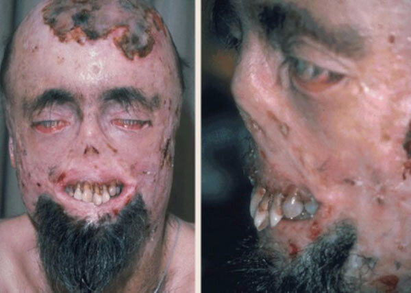 Болезнь Гюнтера, эритропоэтическая порфирия. 