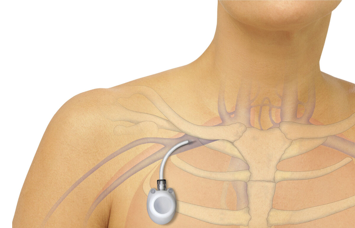 Порт система Для химиотерапии