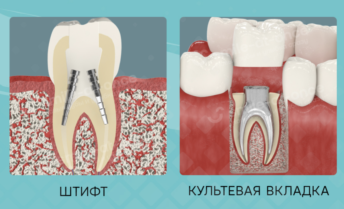 Восстановление зуба на штифте