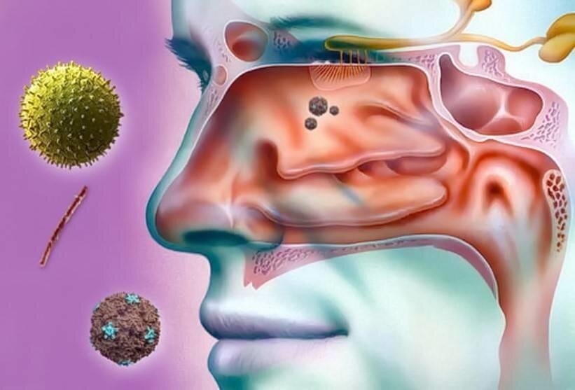 Риносинусит. Полипозный риносинусит этиология. Хронический полипозный синусит. Двусторонний полипозный пансинусит.