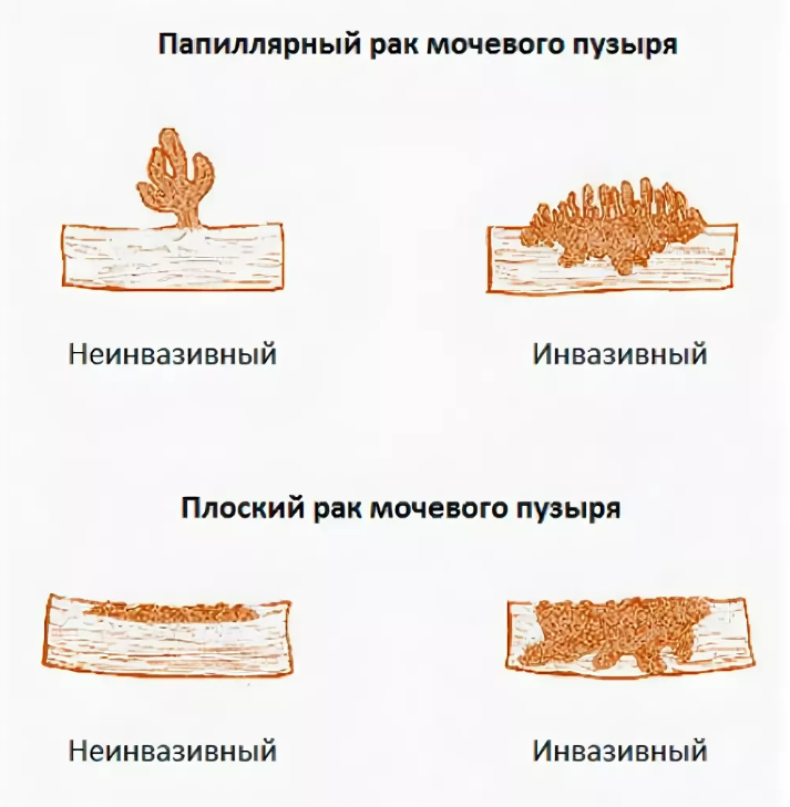 Рак мочевого пузыря клиническая картина