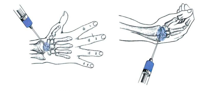 Пункция лучезапястного сустава методика. Пункция локтевого сустава. Блокада запястного сустава. Блокада лучезапястного сустава техника. Уколов уколы в кисть