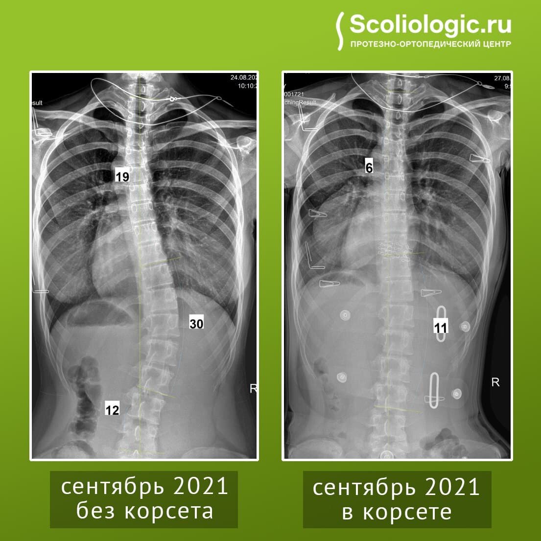 Сколько лечится сколиоз