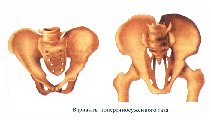 Поперечный таз. Поперечносуженный Робертовский таз. Поперечносуженный таз степени сужения. Узкий таз поперечносуженный. Поперечное сужение таза.