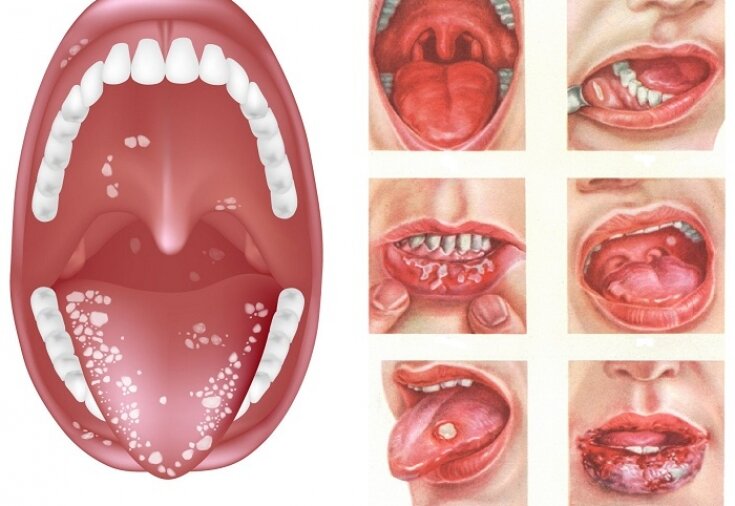 Язвы полости рта | Anaftin®
