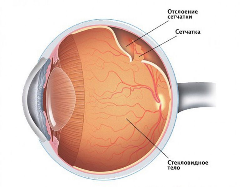 Дистрофия сетчатки: причины, симптомы, лечение глаза