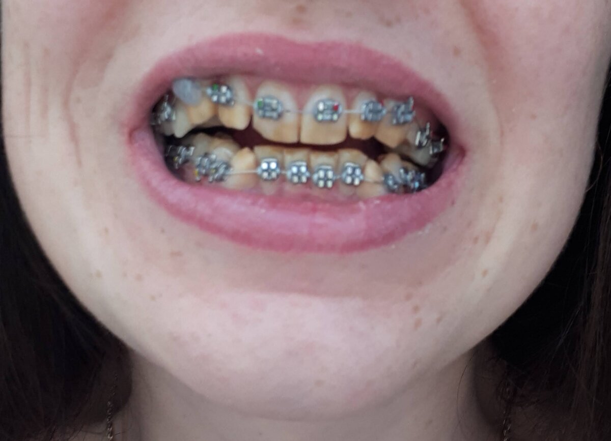 Ко всему прочему, мои зубы ещё и кривые. Здесь мне только установили брекеты. 